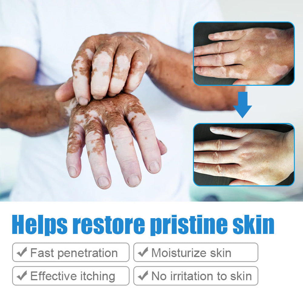 Vitiligo Sweat Spotted Skin Care Repair Cream