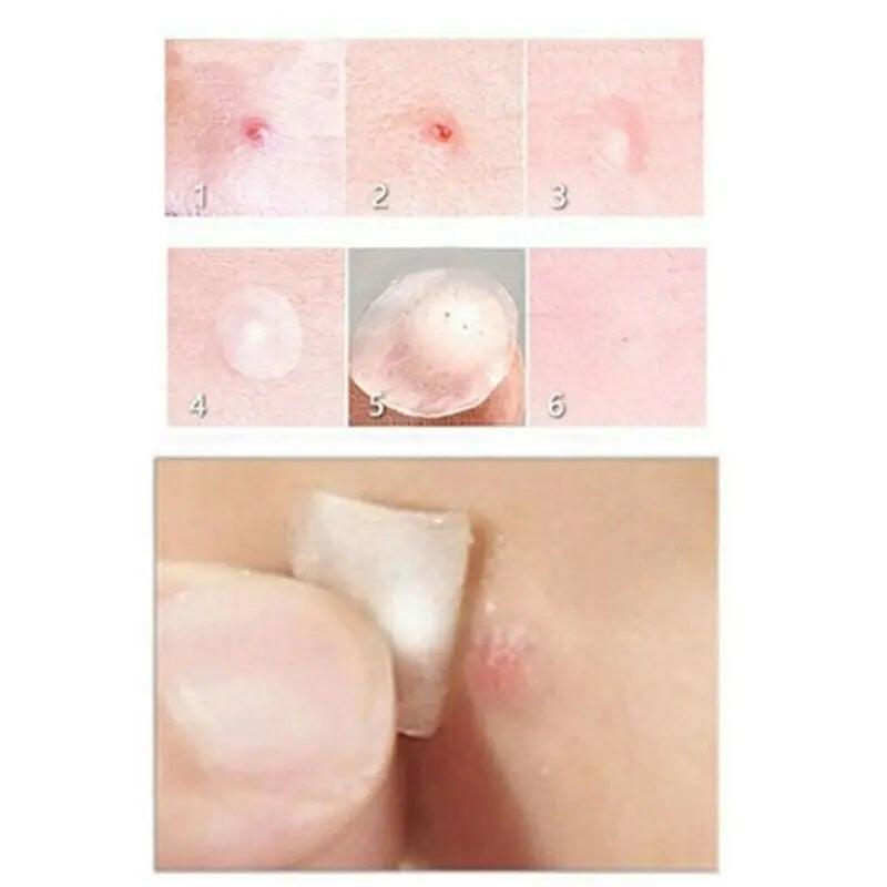 Face Spot Scar Care Treatment Stickers - Zera