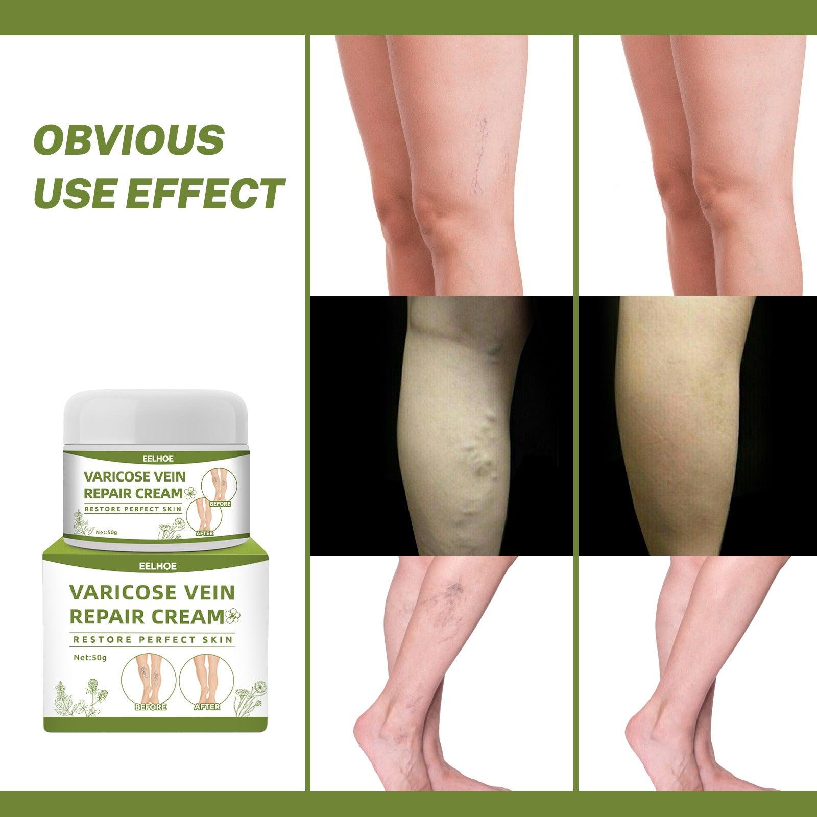 Intravenous Cream To Dredge The Veins And Relieve The Legs