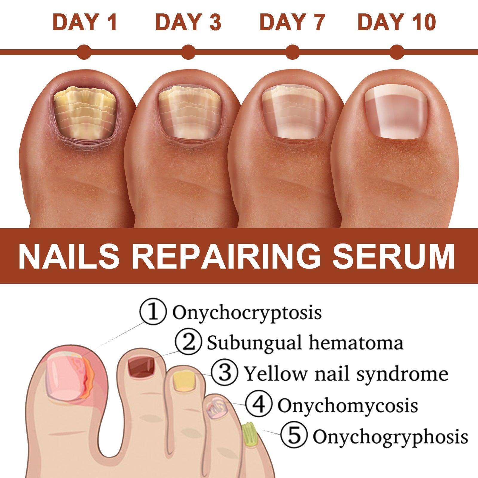 Repair Inlay Nail Thickening Type Dust Hand And Foot Nail Repair