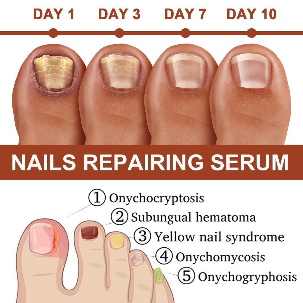 Repair Inlay Nail Thickening Type Dust Hand And Foot Nail Repair