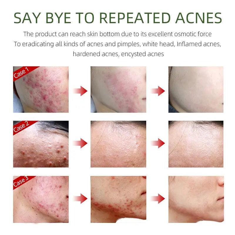 Herbal Acne Removal Face Cream - Zera
