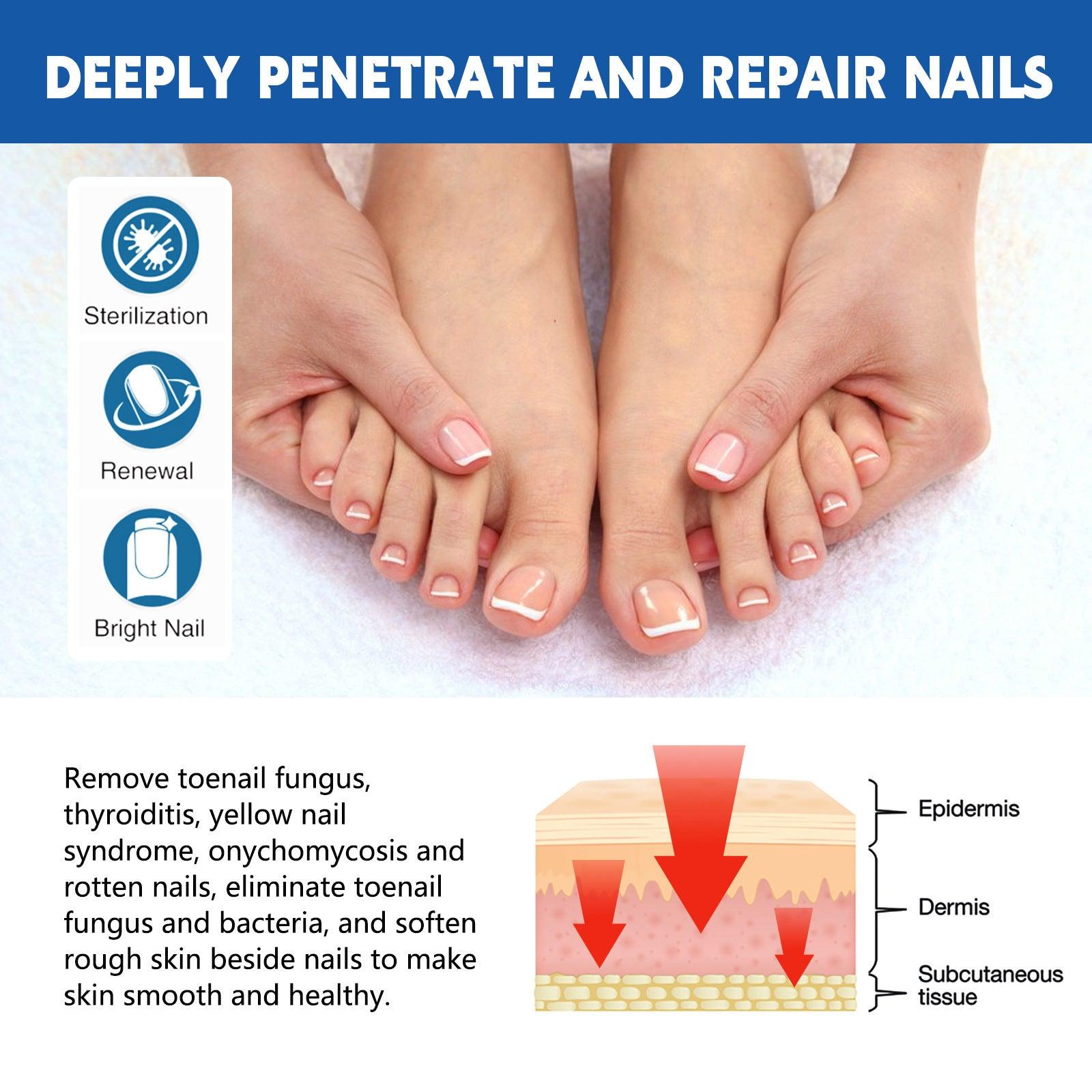 Nail Groove Nursing Adhesive Bandage Repair Thickened Gray Nail Soft Nail Correction
