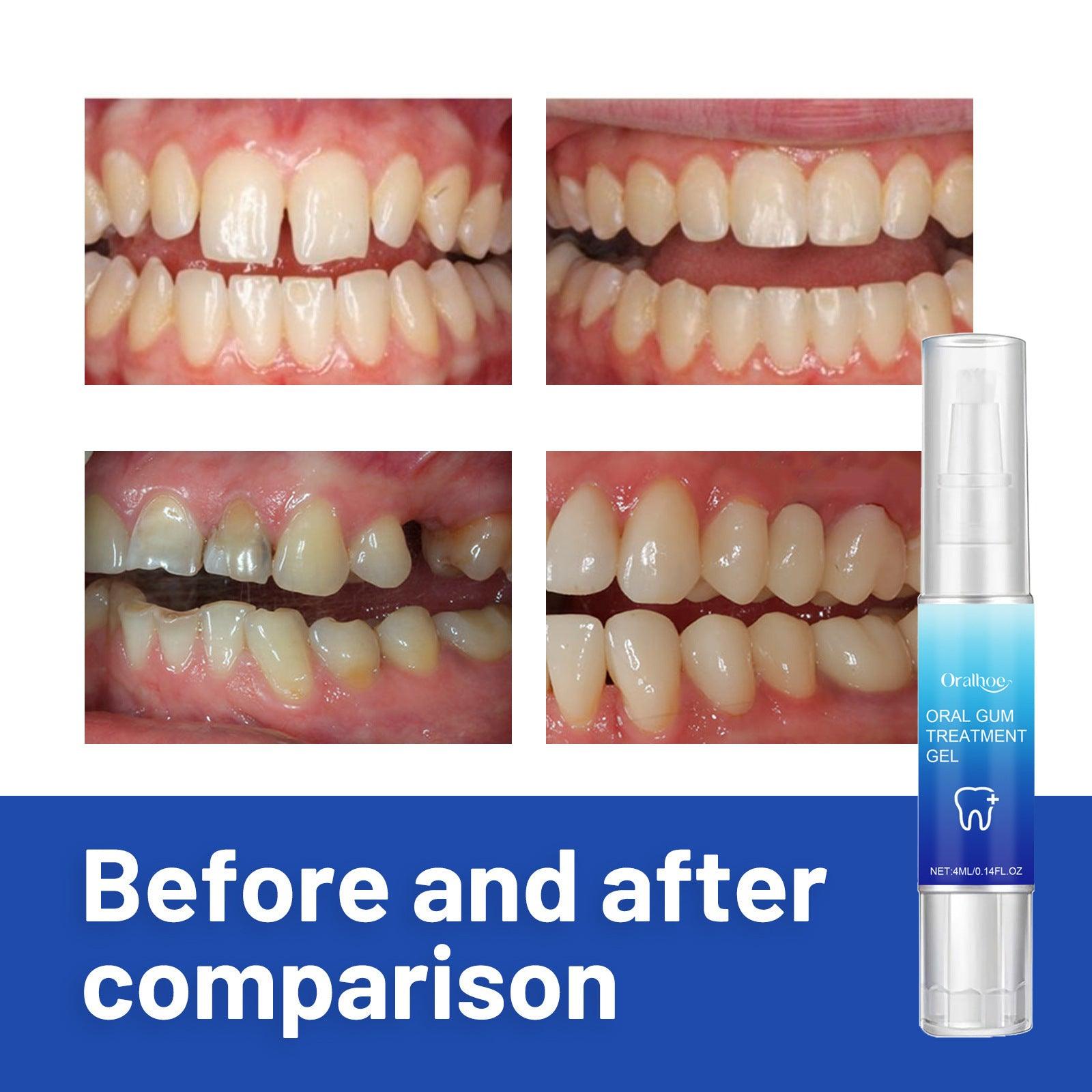 Repair Gel Relieves Swelling And Aching Of Gum