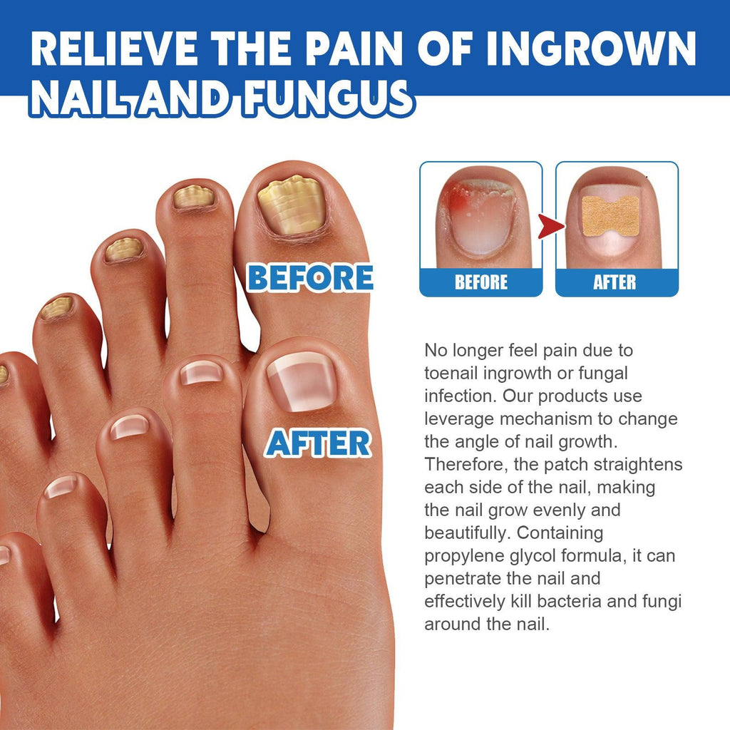 Nail Groove Nursing Adhesive Bandage Repair Thickened Gray Nail Soft Nail Correction