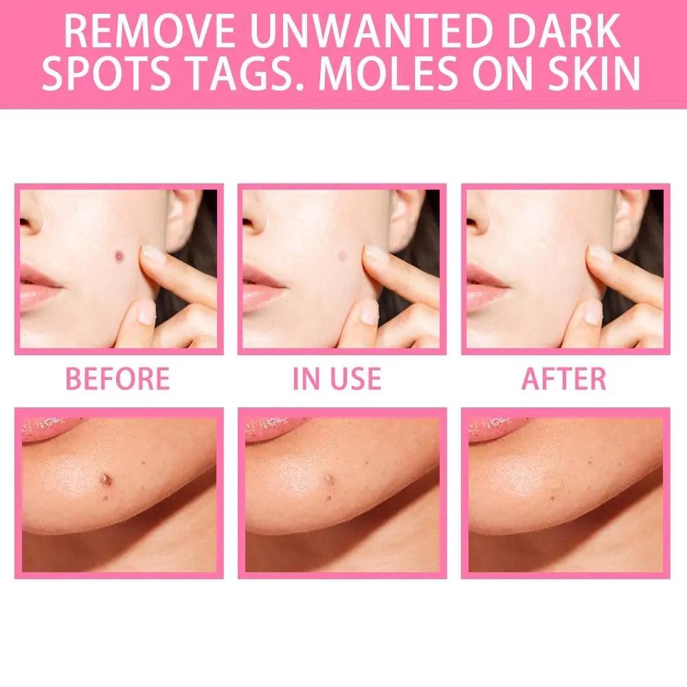 Organic Tags Solutions Serum No Trace Painle Skin Tag Remover Serum Mole Removal Cream Painless Face Wart Mole Freckle - BEAUTIRON