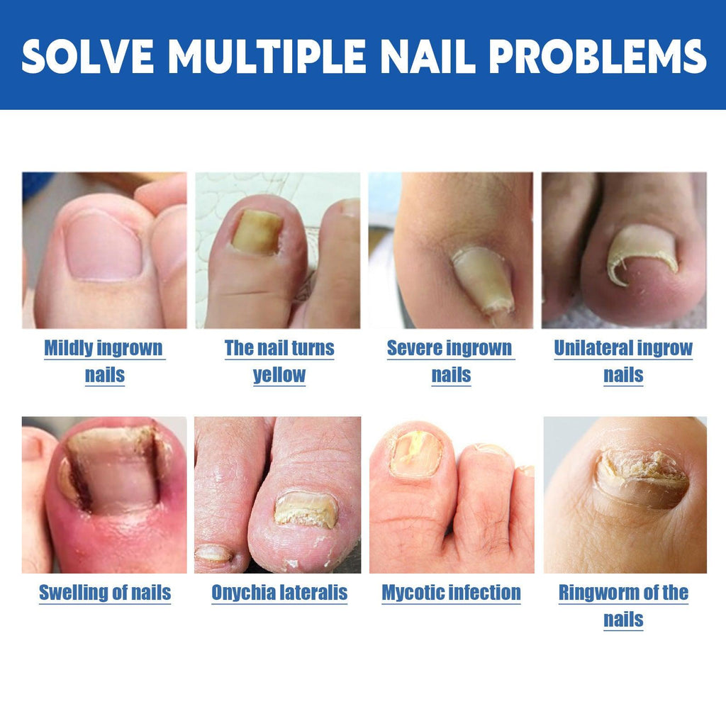 Nail Groove Nursing Adhesive Bandage Repair Thickened Gray Nail Soft Nail Correction