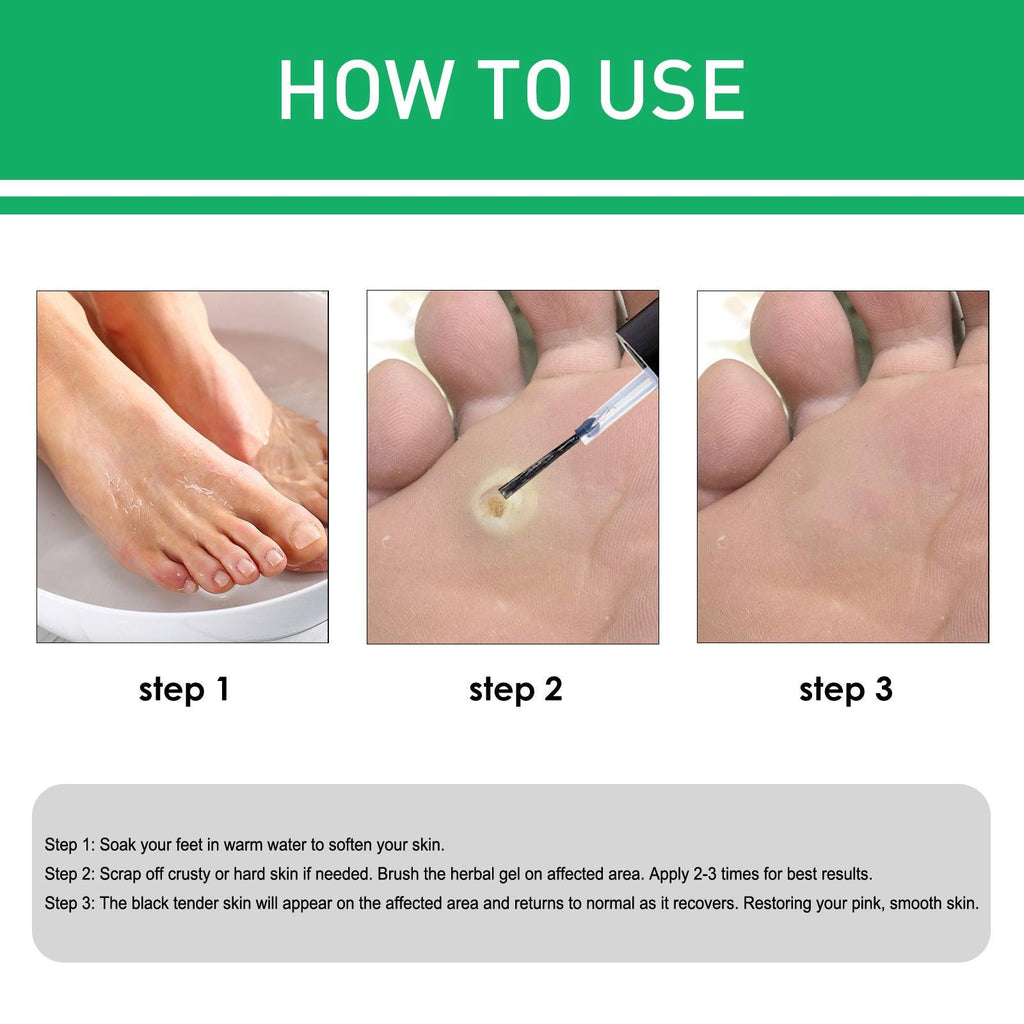Wart Removal Corns Smoothing Skin Gentle Foot Care Solution