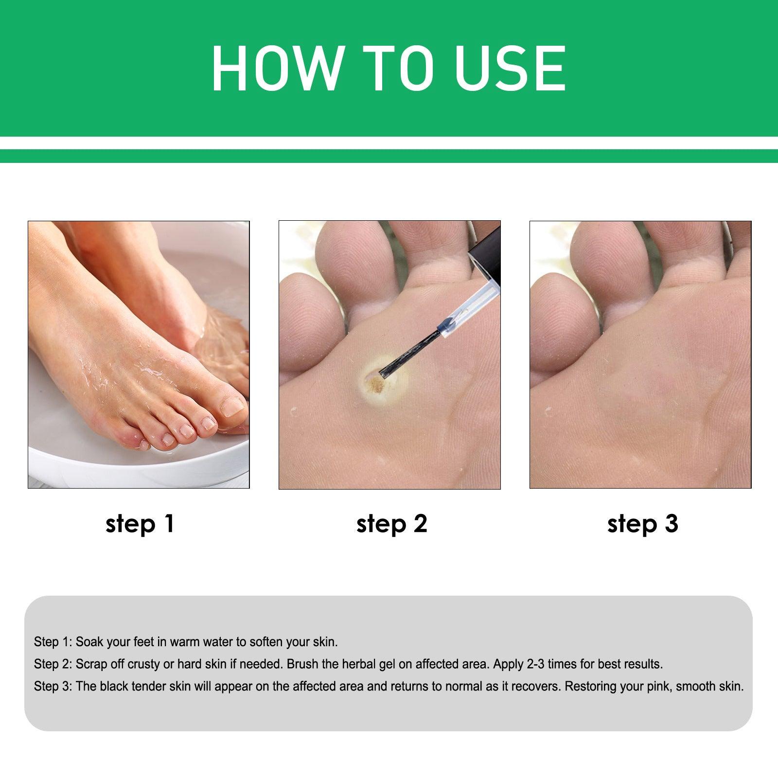 Wart Removal Corns Smoothing Skin Gentle Foot Care Solution