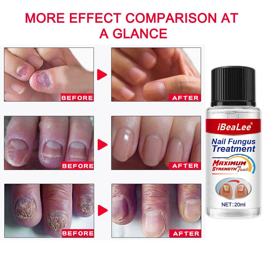 Thickening Of Special Bacteriostatic Liquid For Onychomycosis