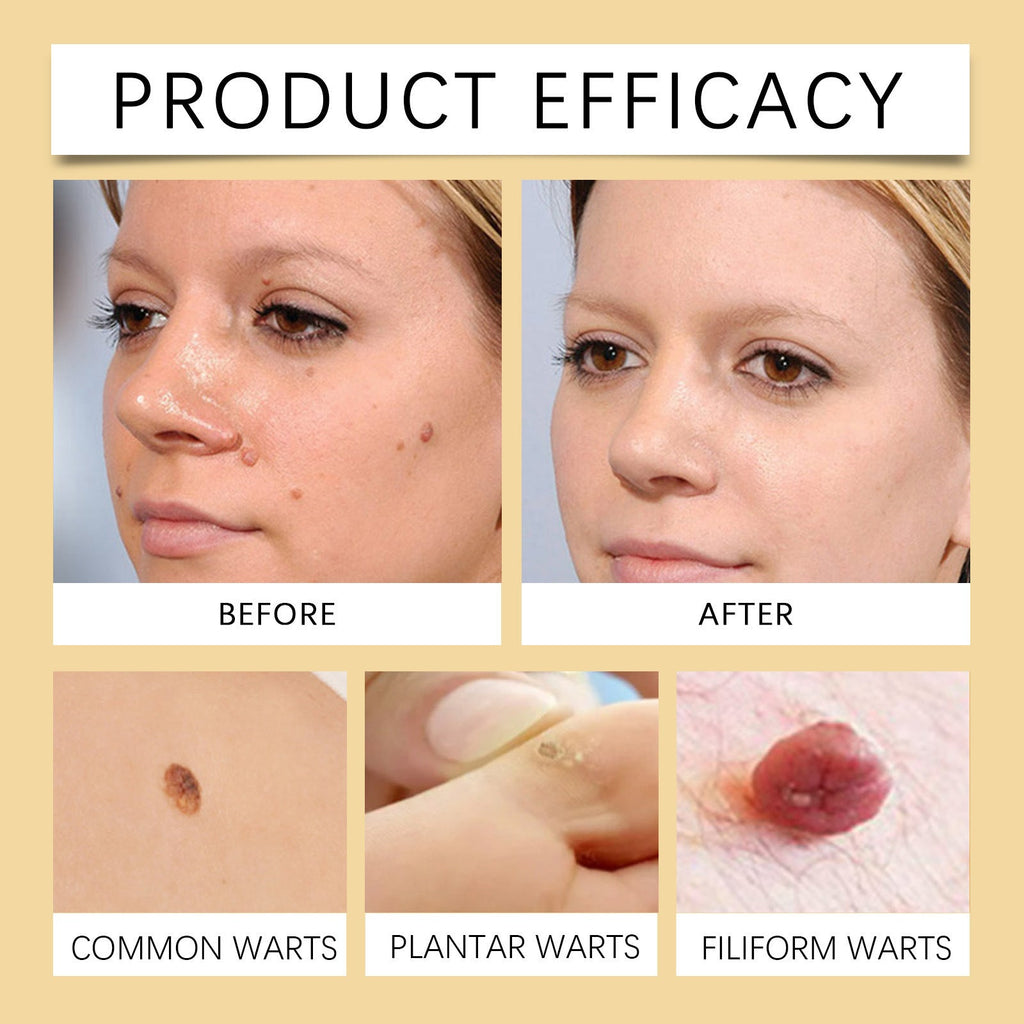 Bee venom for a treatment to remove warts