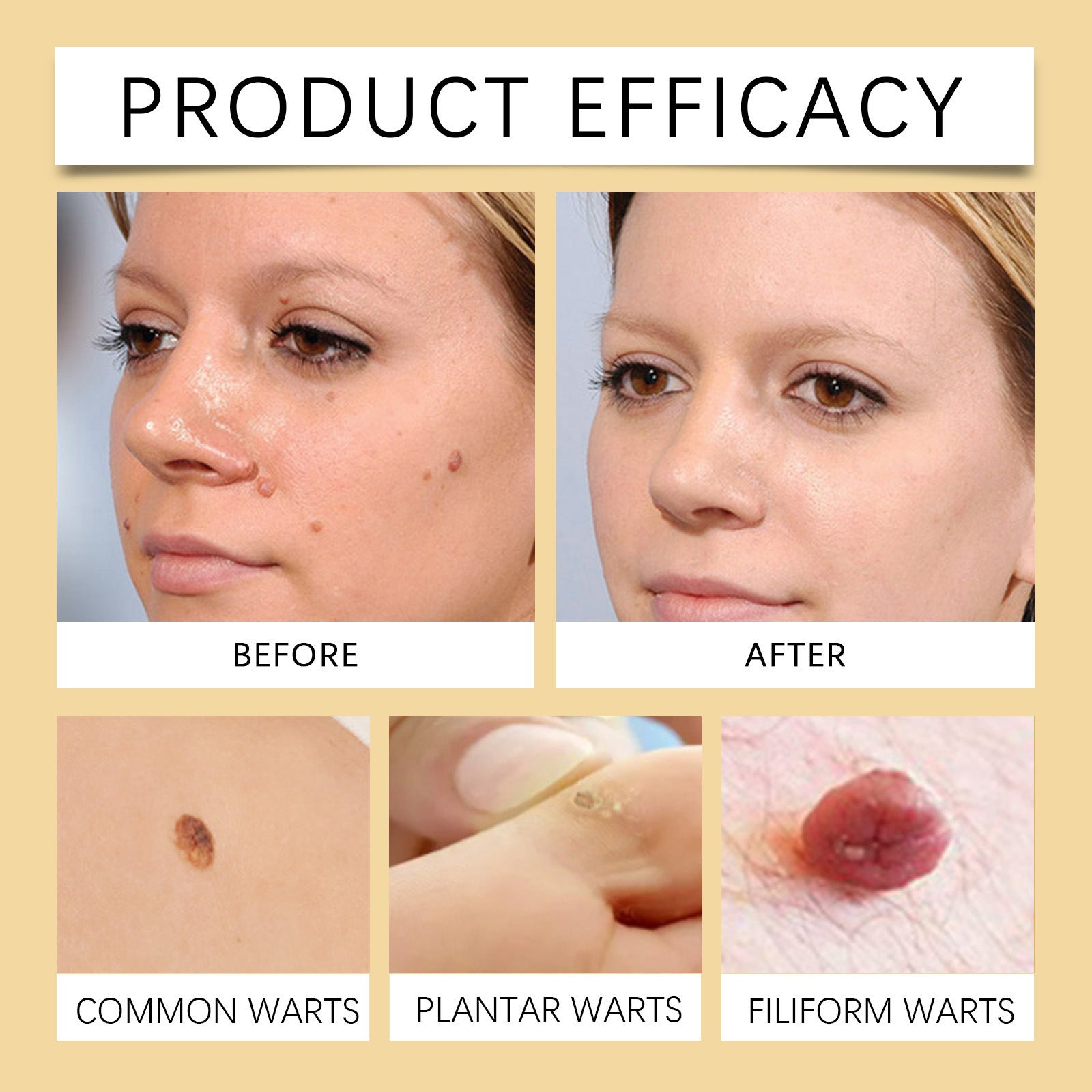 Bee venom for a treatment to remove warts
