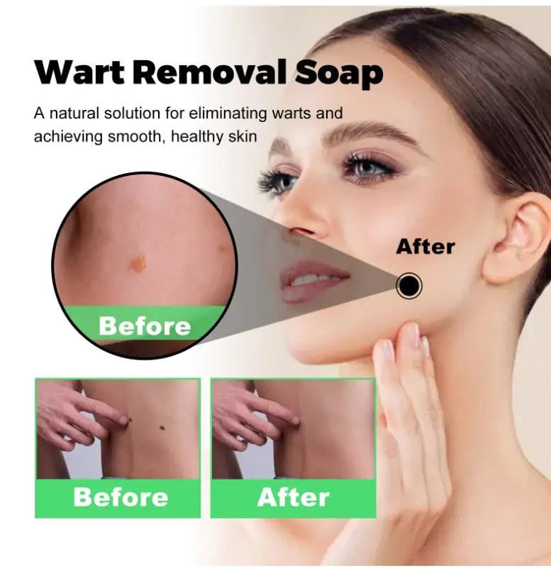 Mole Removal G Wart Grain Filamentous Wart Body Cleaning Soap - BEAUTIRON
