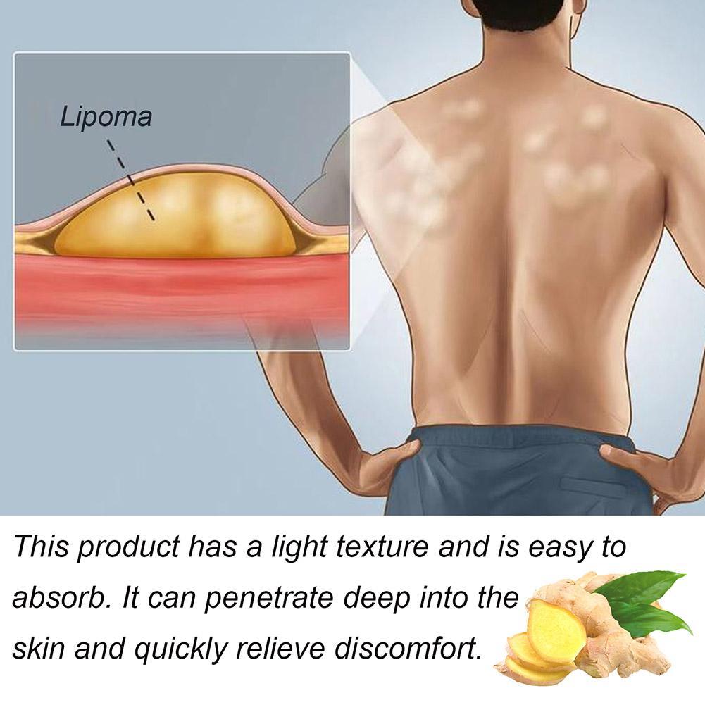 1pc Lipoma Removal Herbal Cream Body Cream Dissolving Fat Easy To Use Herbal Lipoma Removal Cream