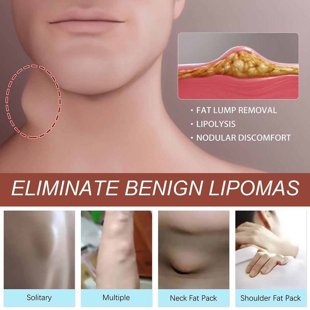 1pc Lipoma Removal Herbal Cream Body Cream Dissolving Fat Easy To Use Herbal Lipoma Removal Cream