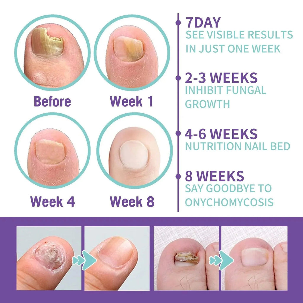 Onychomycosis Repair Spray Nail Fungus Treatment Hand Foot Soft Nail Ingrowing Thickening Nail Cleaning Care Hongos Uñas Pies