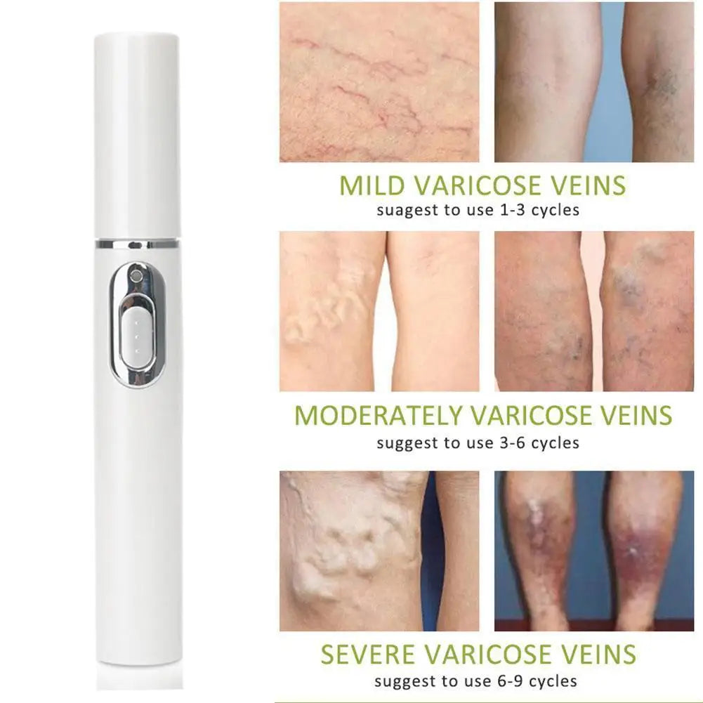 Skin Tag Removal Pen, Mole And Wart Removal Pen High-quality Anti Swelling Vessel Bulge Pain Blood Circulation