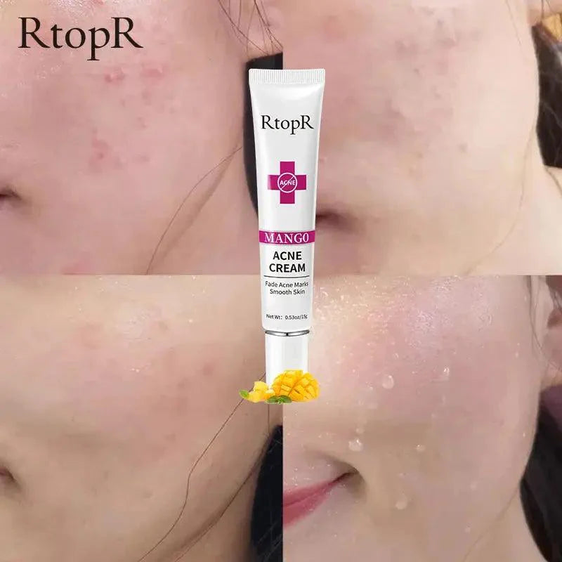 Acne Cream Acne Mark Removal Acne Mild Repair Damaged Skin Hydration Nourishment Rejuvenation Skin Brightening Skin Care - BEAUTIRON