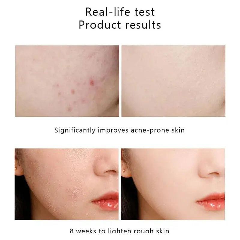 Original Niacinamide 10% + Zinc 1% B5 Essence Fruit Acid 30% Salicylic Caffeine Vitamin Moisturizes Tightens Soften Skin Care - BEAUTIRON