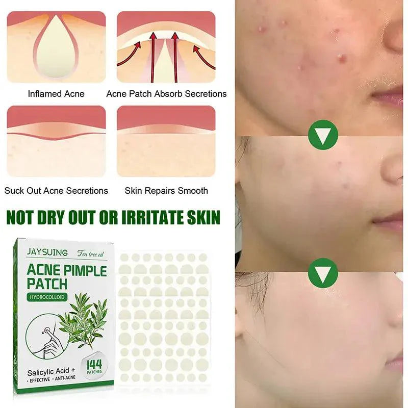 144 Patches Acne Pimple Patch Face Invisible Stickers Quick Effect Treatment Removing Patches Beauty Acne Tools Face Skin Care - BEAUTIRON