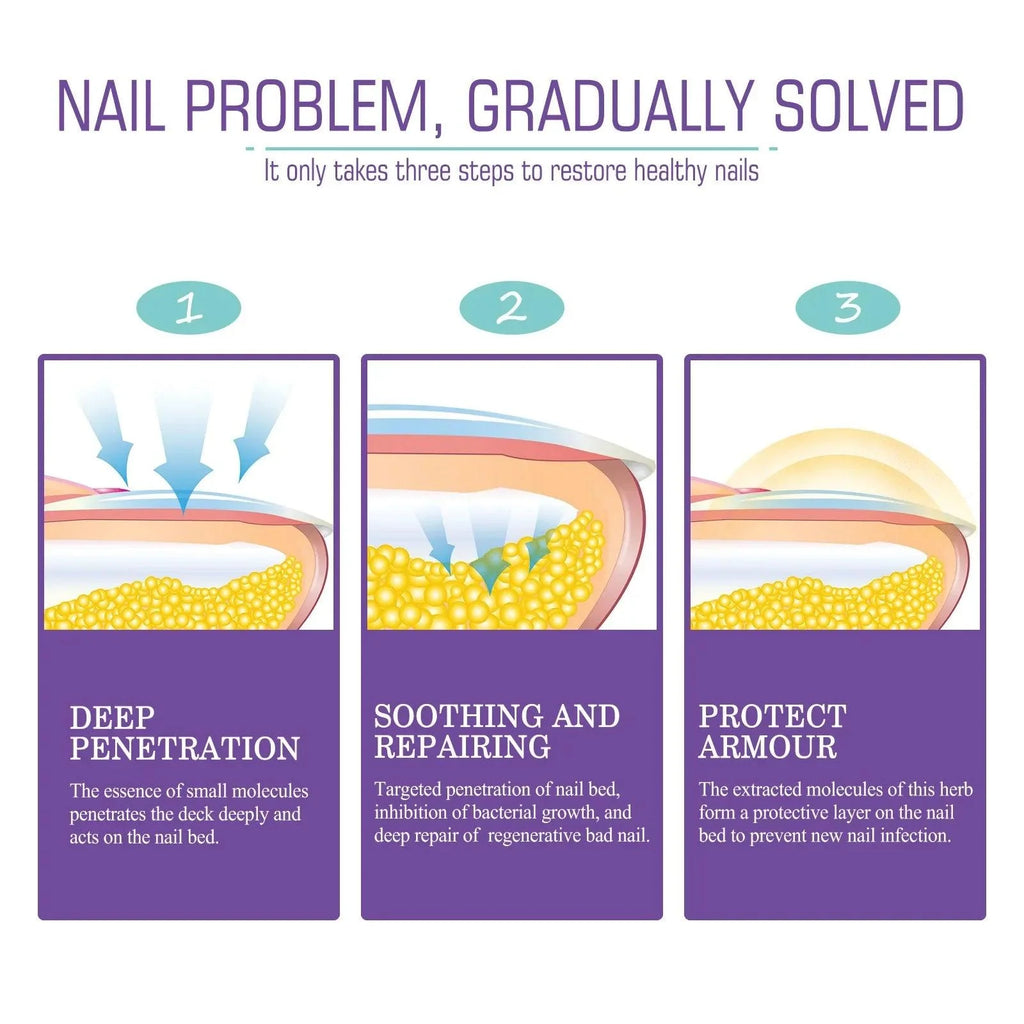 Onychomycosis Repair Spray Nail Fungus Treatment Hand Foot Soft Nail Ingrowing Thickening Nail Cleaning Care Hongos Uñas Pies