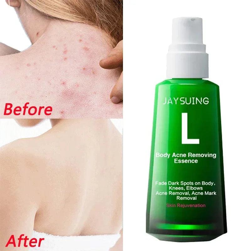 Acne serum for pimple for body and face