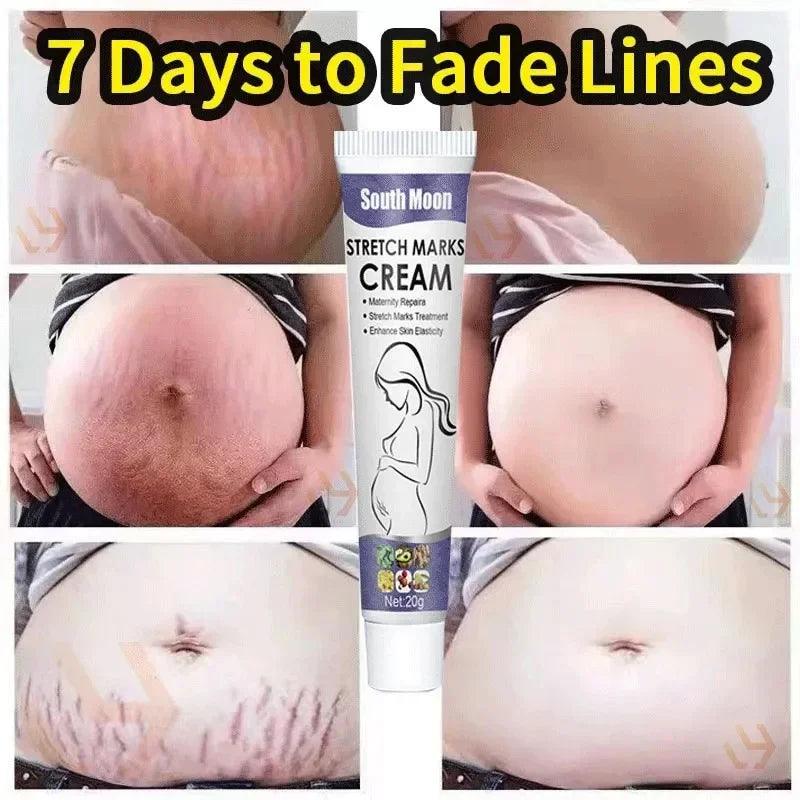 Stretch Mark Permanent Remover Stretch Mark Removal Cream White Stretch Mark Remover Stretch Mark Remover Free Shipping