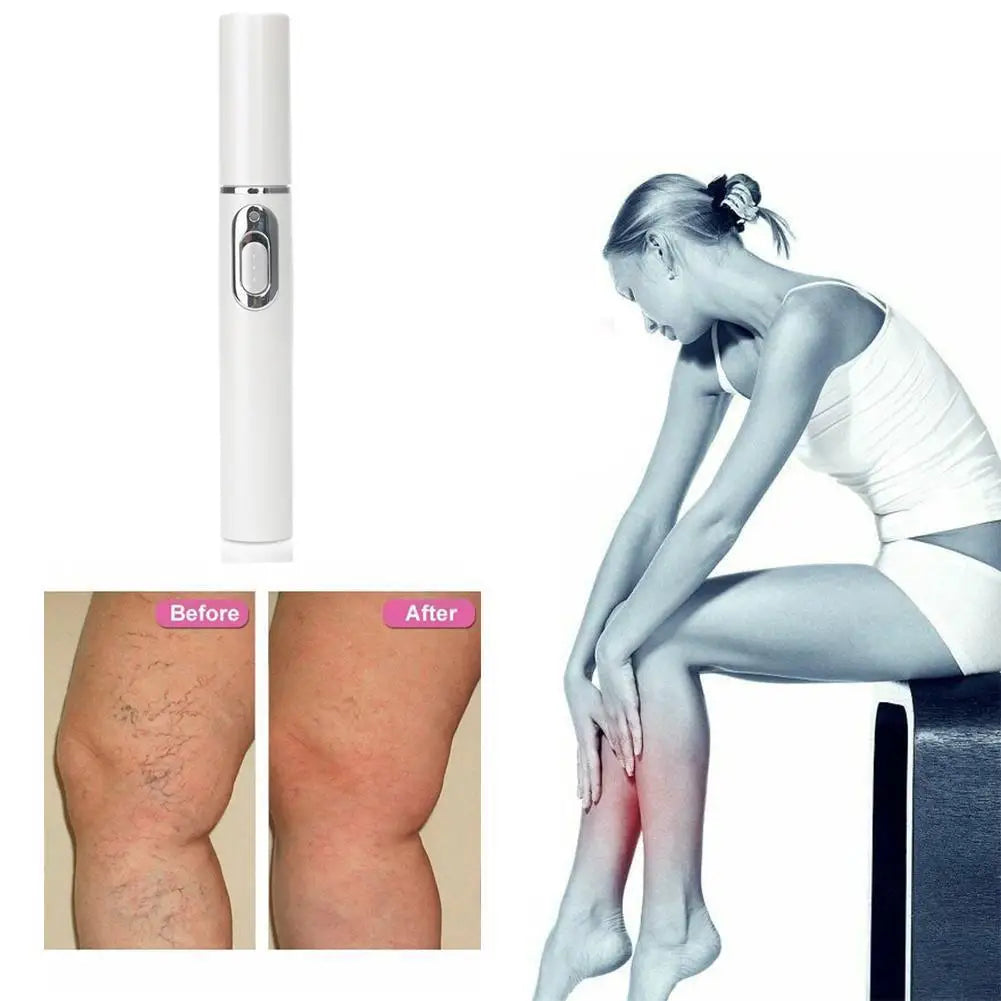 Skin Tag Removal Pen, Mole And Wart Removal Pen High-quality Anti Swelling Vessel Bulge Pain Blood Circulation