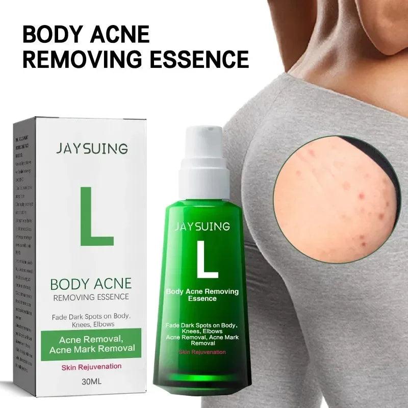 Acne serum for pimple for body and face
