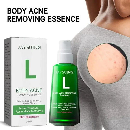 Acne serum for pimple for body and face