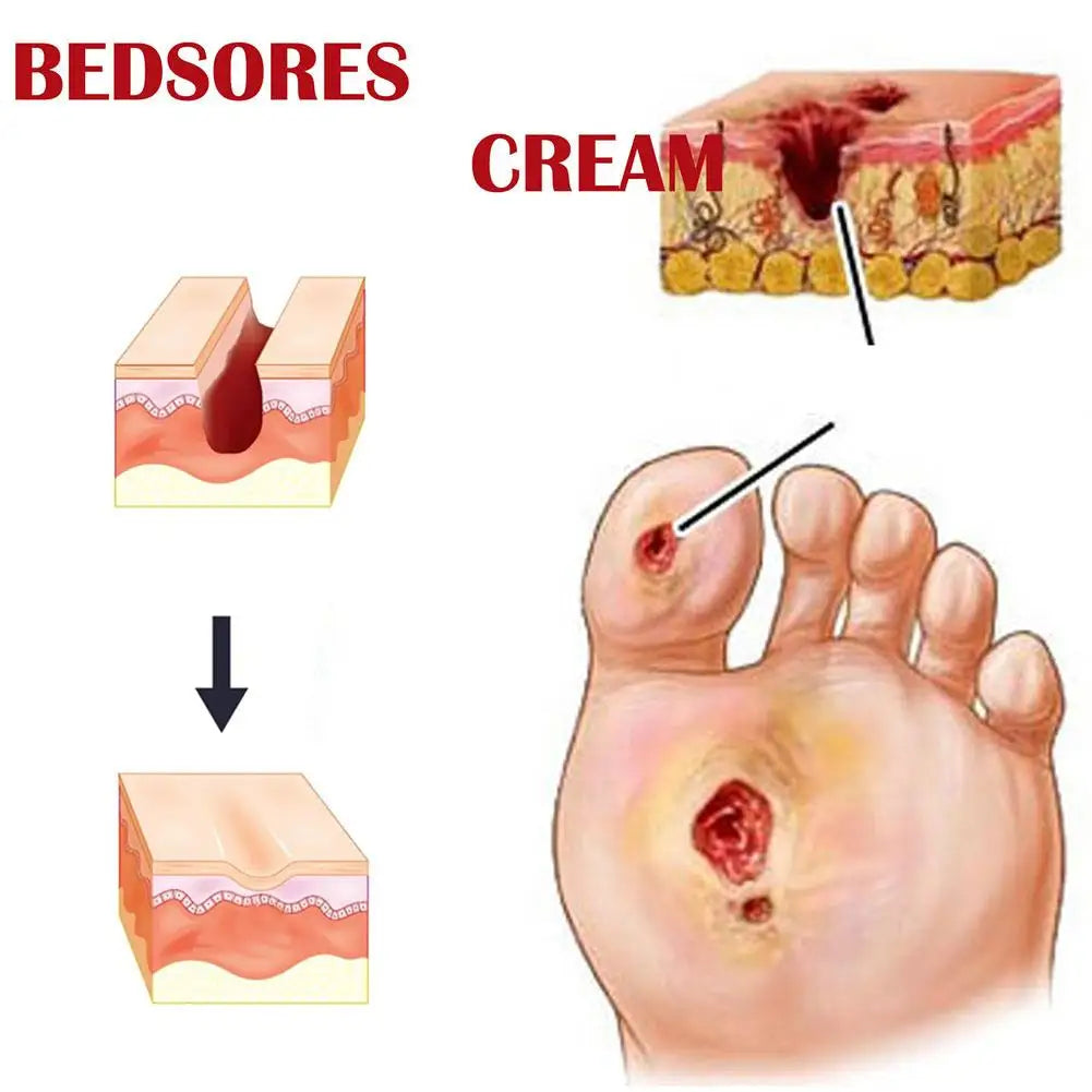 Bedsore Treatment Cream Pressure Sore Ulcer Skin Rot Necrotic Repair Relief Ointment Bed Sore Wound Healing Decubitus Feet Care