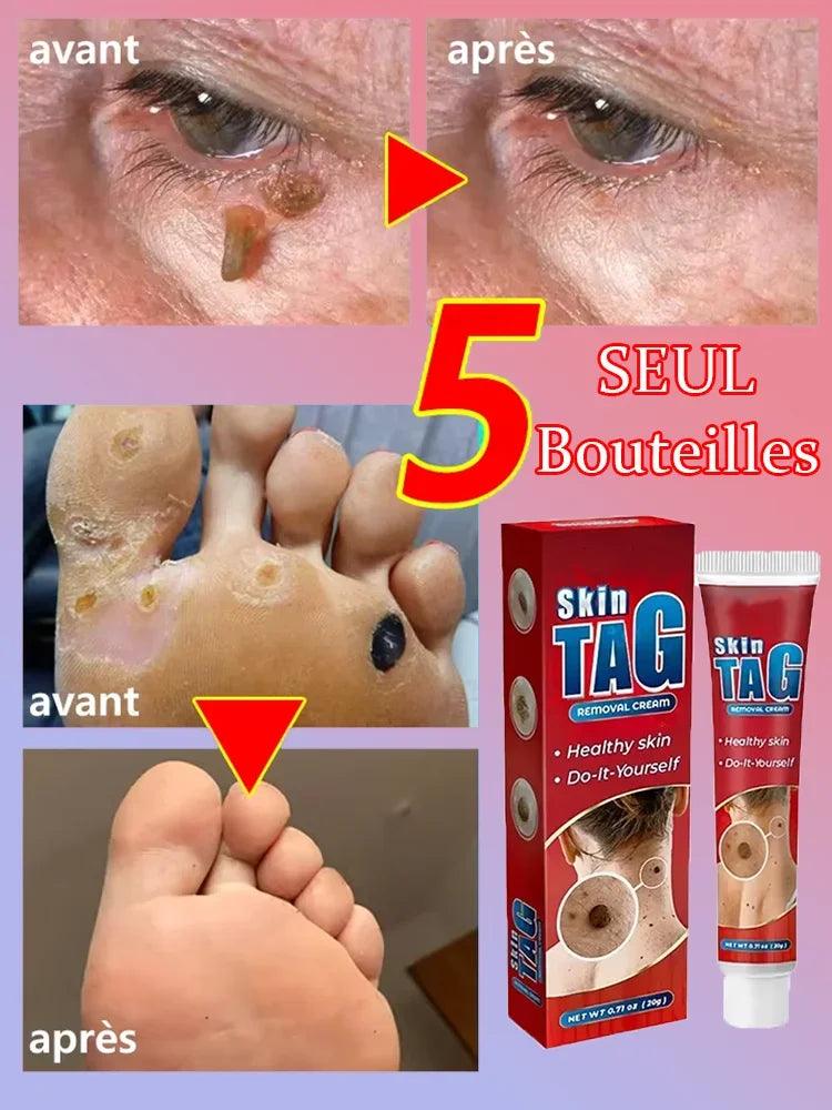 Wart, Freckle, Skin Tag, Mole, Dark Spot Removal Eyelift