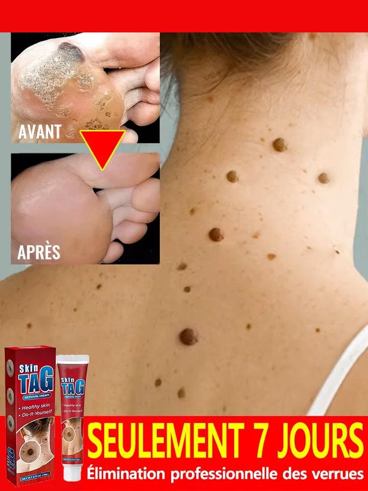 Wart, Freckle, Skin Tag, Mole, Dark Spot Removal Eyelift