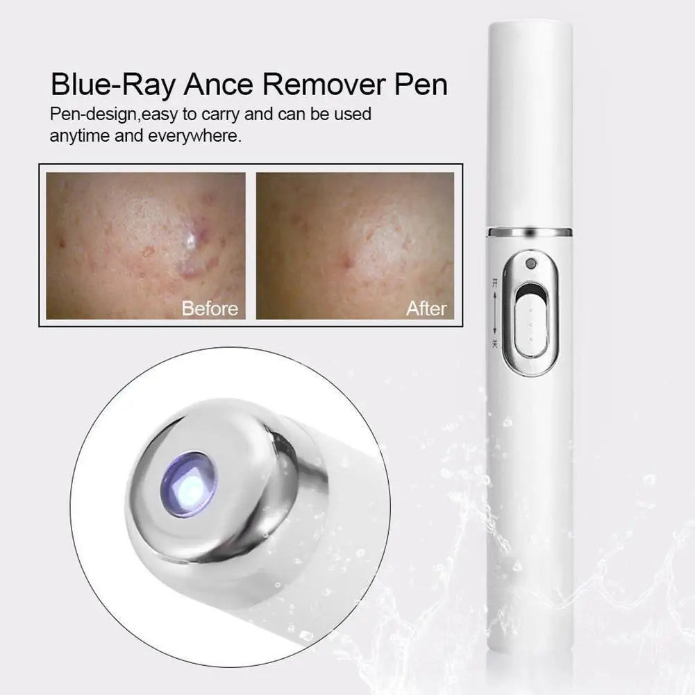 Skin Tag Removal Pen, Mole And Wart Removal Pen High-quality Anti Swelling Vessel Bulge Pain Blood Circulation