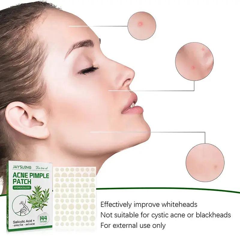 144 Patches Acne Pimple Patch Face Invisible Stickers Quick Effect Treatment Removing Patches Beauty Acne Tools Face Skin Care - BEAUTIRON