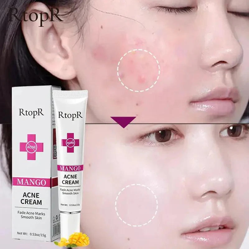 Acne Cream Acne Mark Removal Acne Mild Repair Damaged Skin Hydration Nourishment Rejuvenation Skin Brightening Skin Care - BEAUTIRON