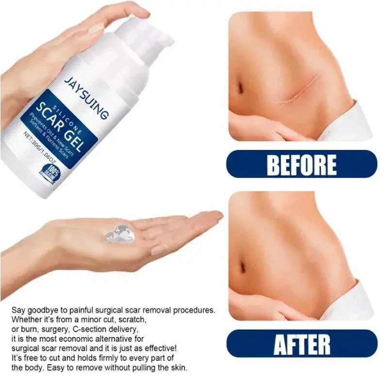 100% Silicone Scar Removal Cream Gel Burn Surgical Scar Cesarean Scar Repairing Stretch Marks Whitening Pigmentation Corrector - BEAUTIRON