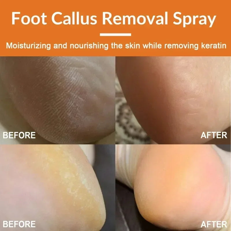 30ml Skin Remover Heel Dry Cracked Blister Repairing Pedicure Exfoliating Nourishing Foot Care Foot Peeling Spray Callus Dead