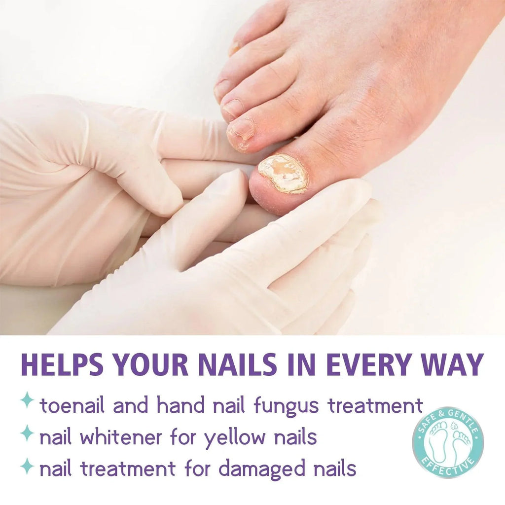Onychomycosis Repair Spray Nail Fungus Treatment Hand Foot Soft Nail Ingrowing Thickening Nail Cleaning Care Hongos Uñas Pies