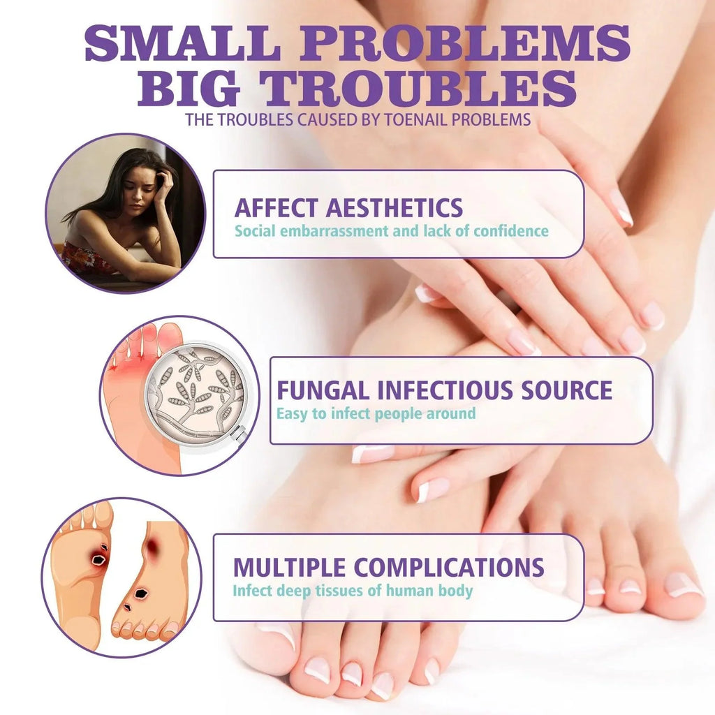 Onychomycosis Repair Spray Nail Fungus Treatment Hand Foot Soft Nail Ingrowing Thickening Nail Cleaning Care Hongos Uñas Pies