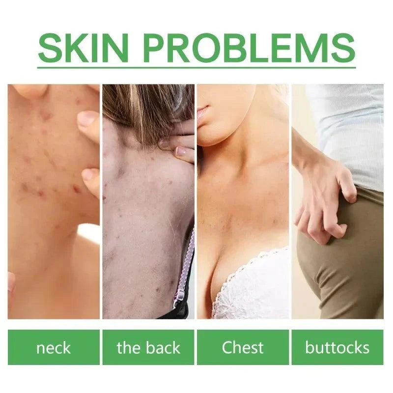 Acne serum for pimple for body and face