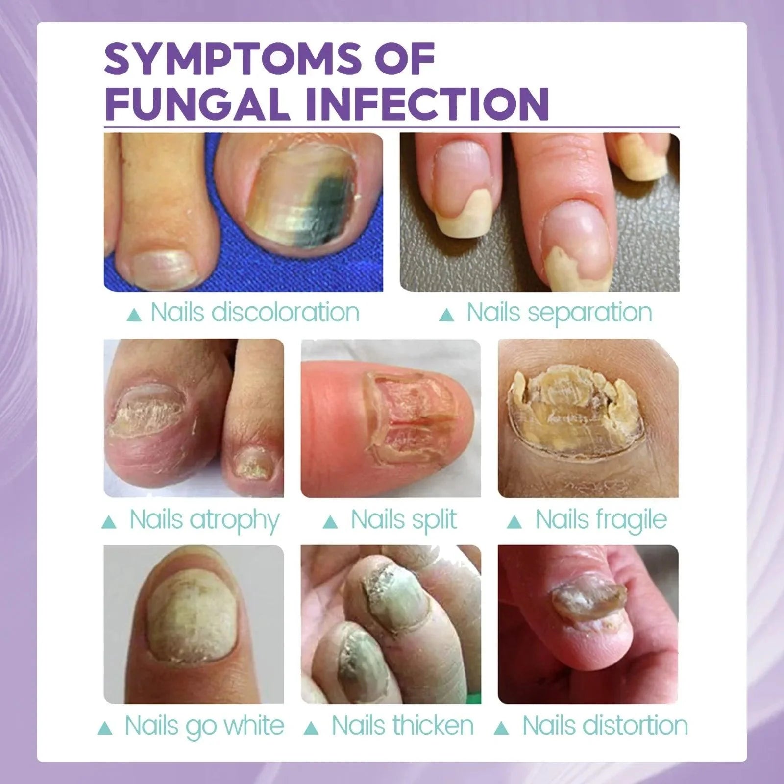 Onychomycosis Repair Spray Nail Fungus Treatment Hand Foot Soft Nail Ingrowing Thickening Nail Cleaning Care Hongos Uñas Pies