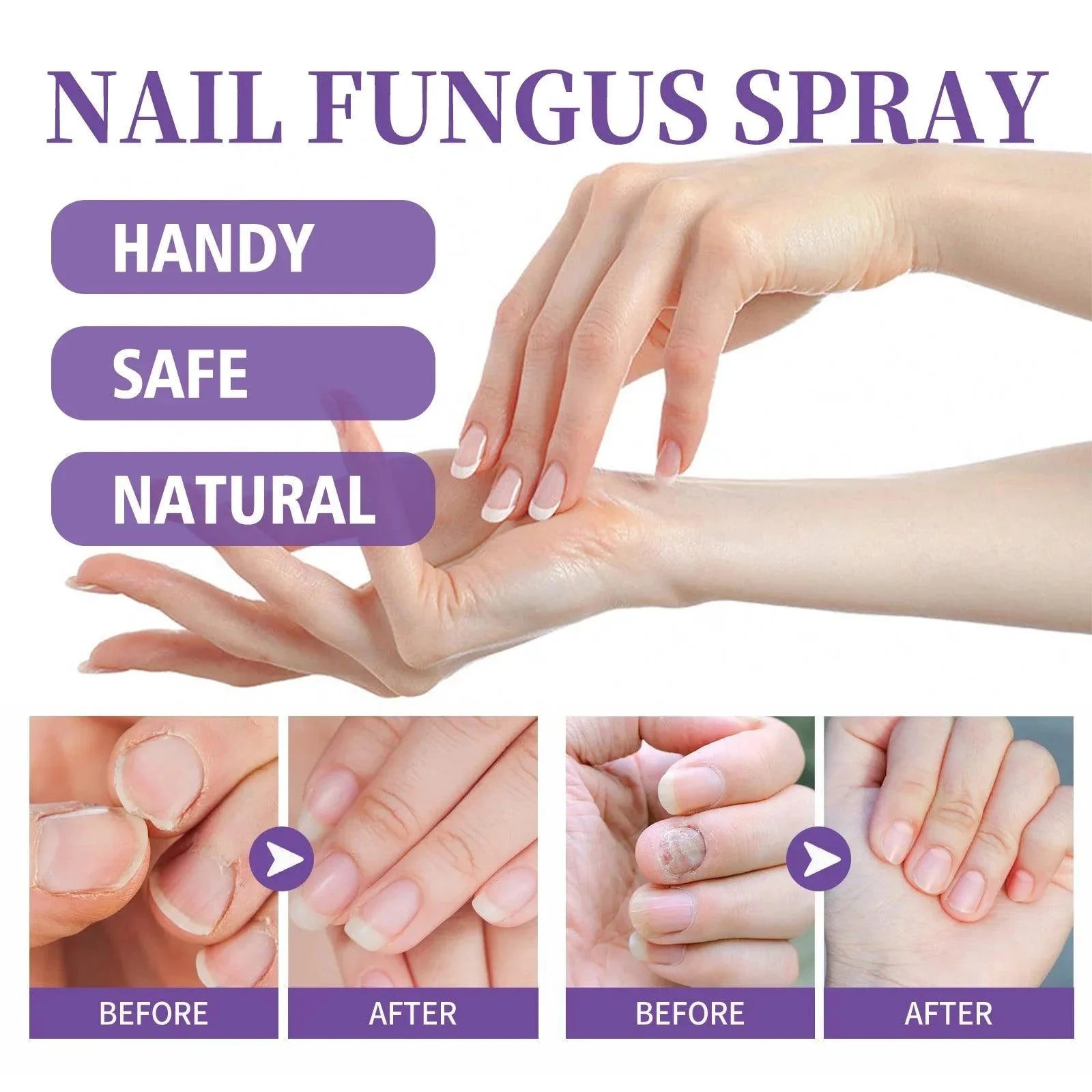 Onychomycosis Repair Spray Nail Fungus Treatment Hand Foot Soft Nail Ingrowing Thickening Nail Cleaning Care Hongos Uñas Pies