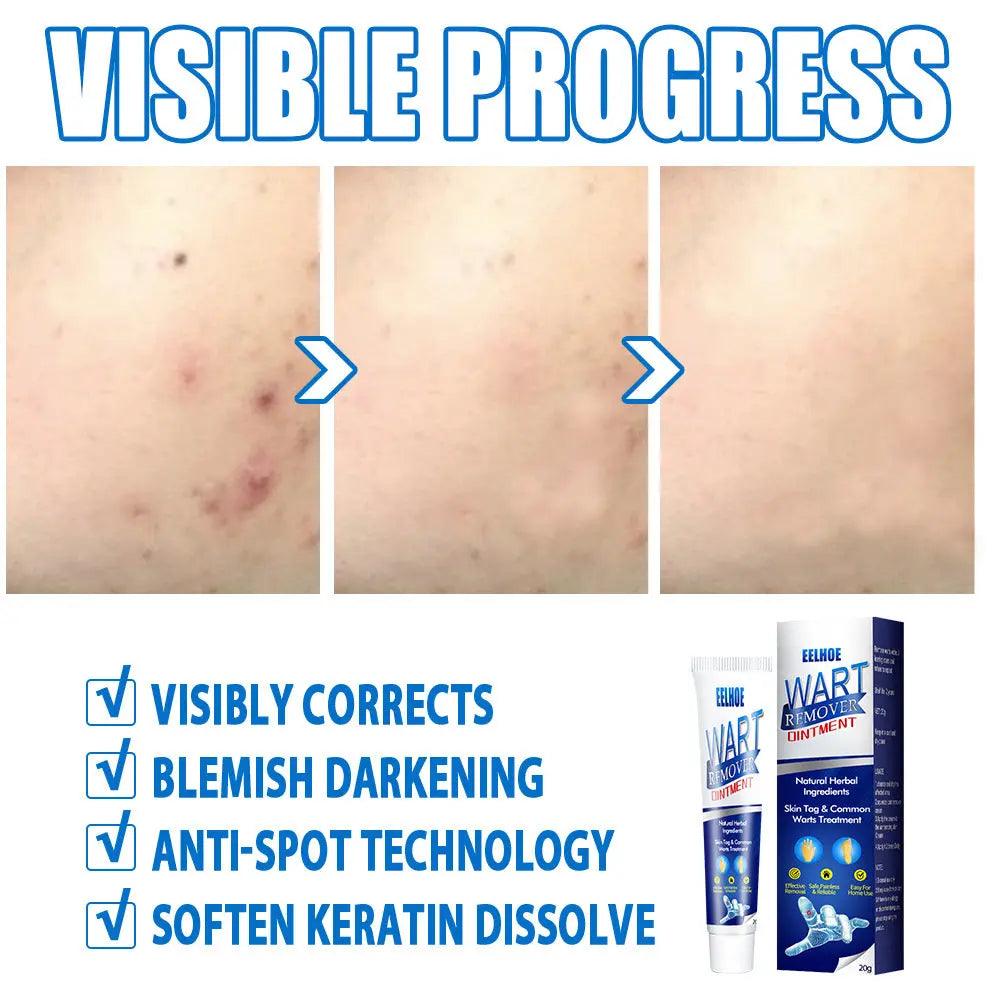 Warts Remover Antibacterial Ointment Wart Treatment Cream Skin Tag Remover Herbal Extract Corn Plaster Warts Ointment - BEAUTIRON