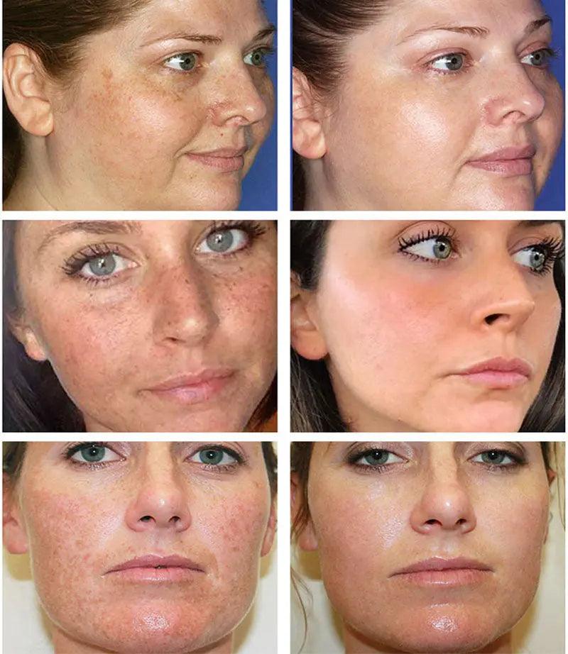 Whitening And Freckle Cream To Reduce Spots And Moisturizing - Zera