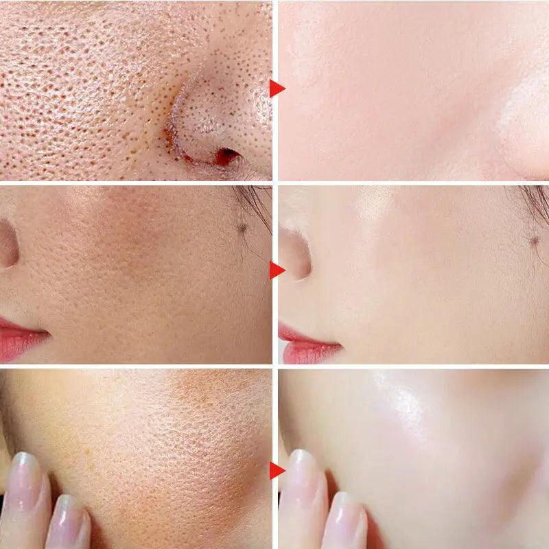 Herbal Acne Removal Face Cream - Zera