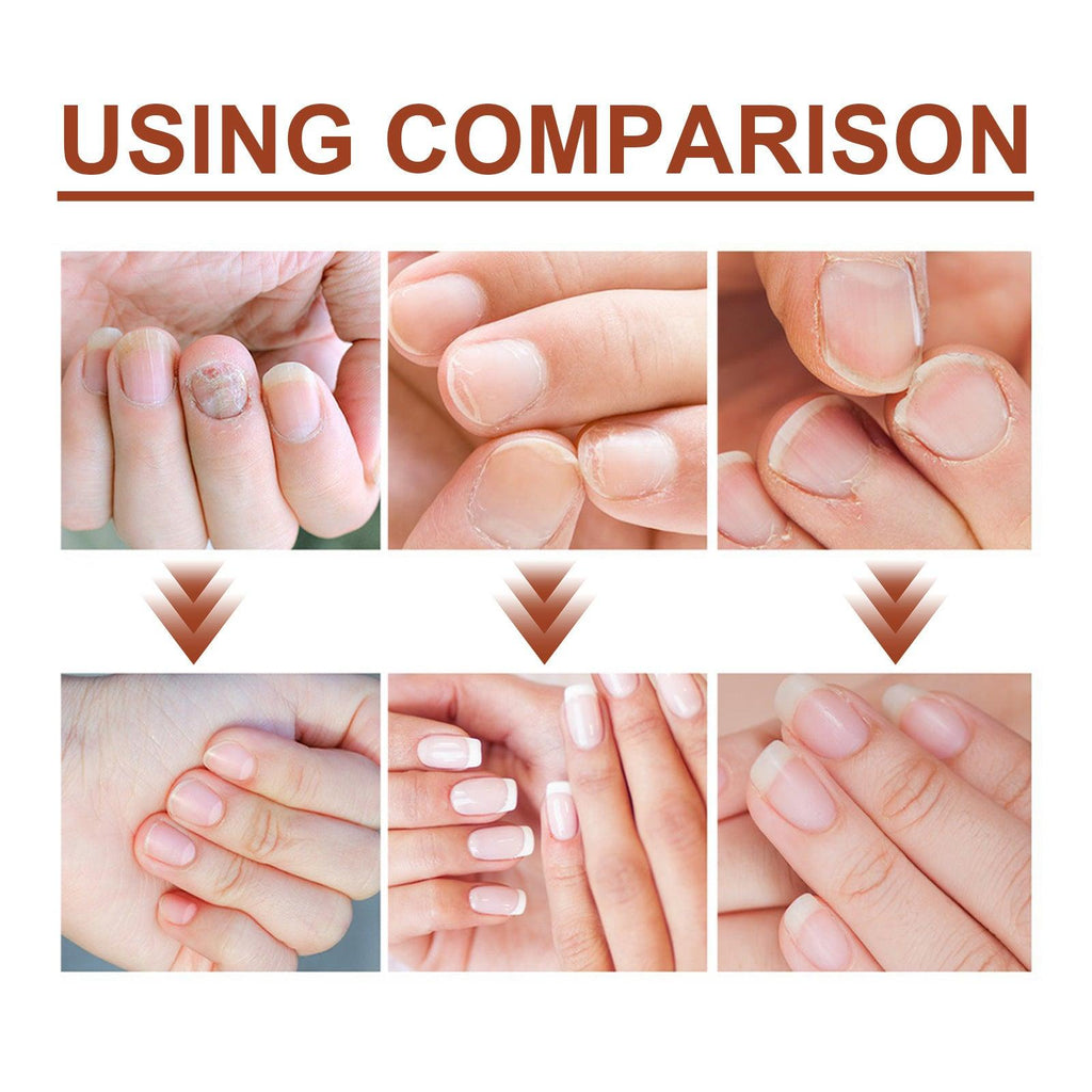 Repair Inlay Nail Thickening Type Dust Hand And Foot Nail Repair