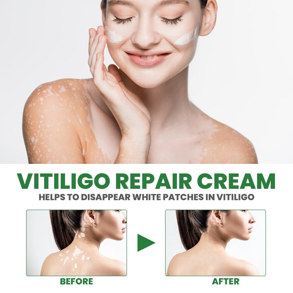 White Spot Repair Cream Melanin Repair Even Skin Color For External Use